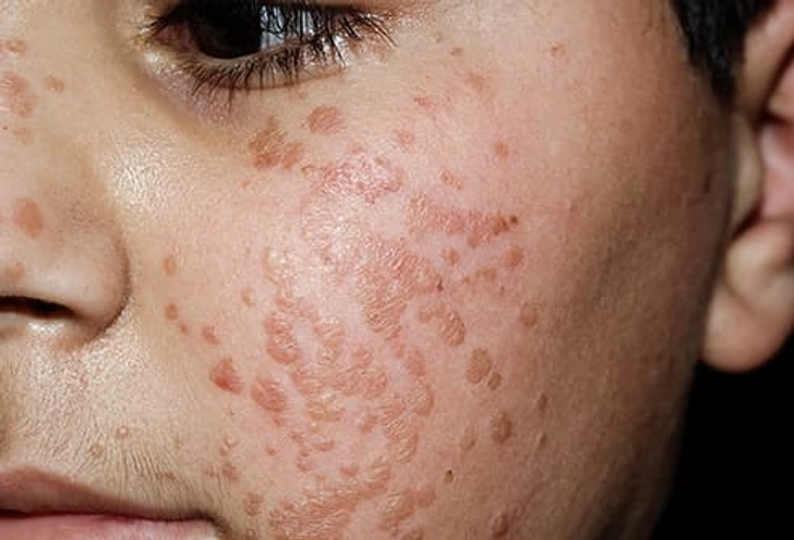 Flat Warts