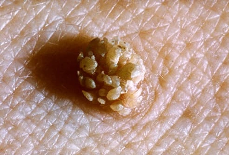 Filiform Warts
