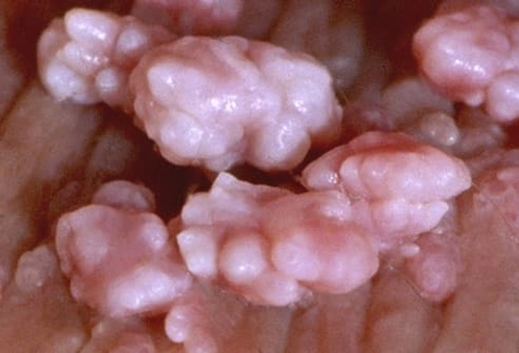 Genital Warts Genital Warts