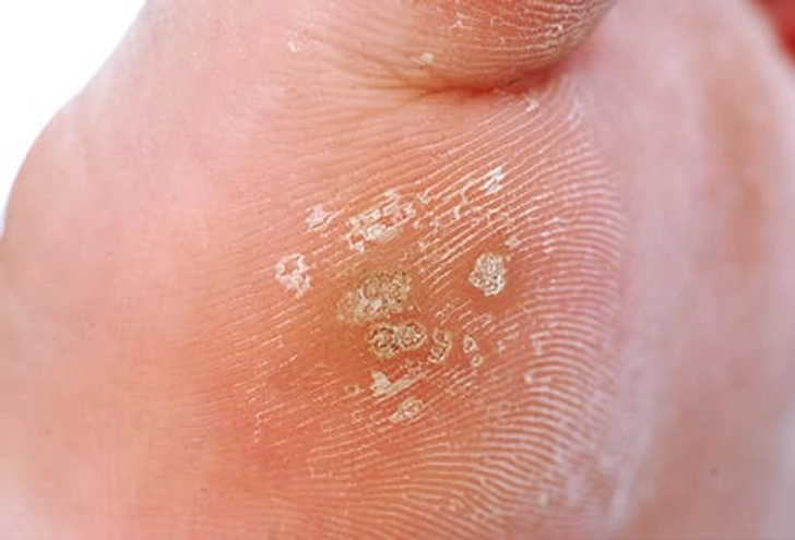 Plantar Warts Plantar Warts