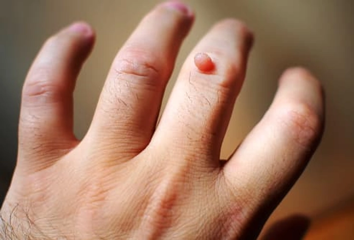 Common Warts