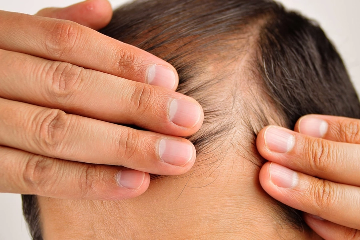 Stop Hair Loss Stop Hair Loss