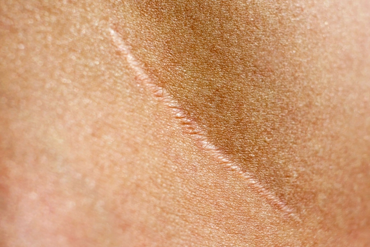Scars Scars