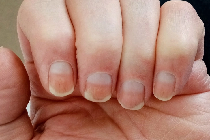 Skin and Nail Changes Skin and Nail Changes