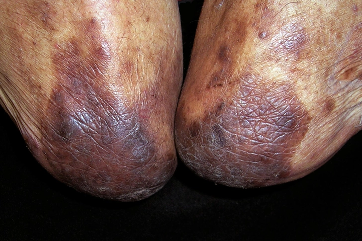 Dyspigmentation