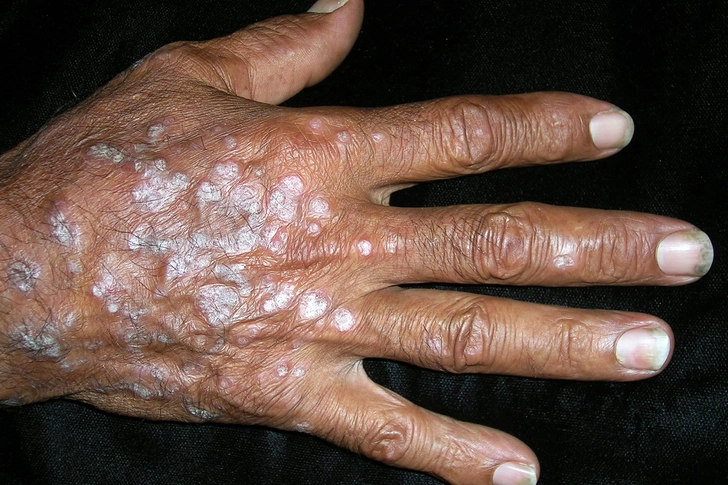 Thick Plaques