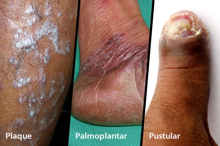 Varieties of Psoriasis