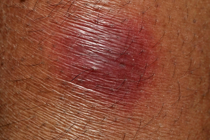 Lower Erythema