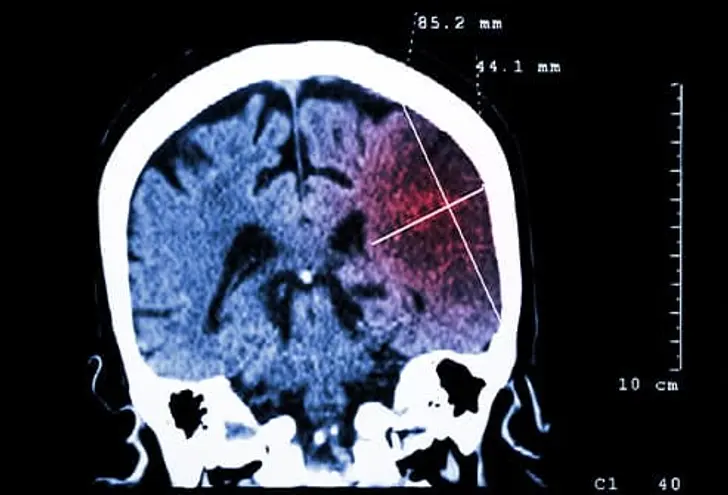 What Is a Stroke?