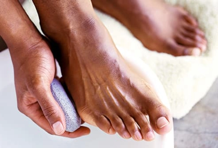 Smooth Corns and Calluses