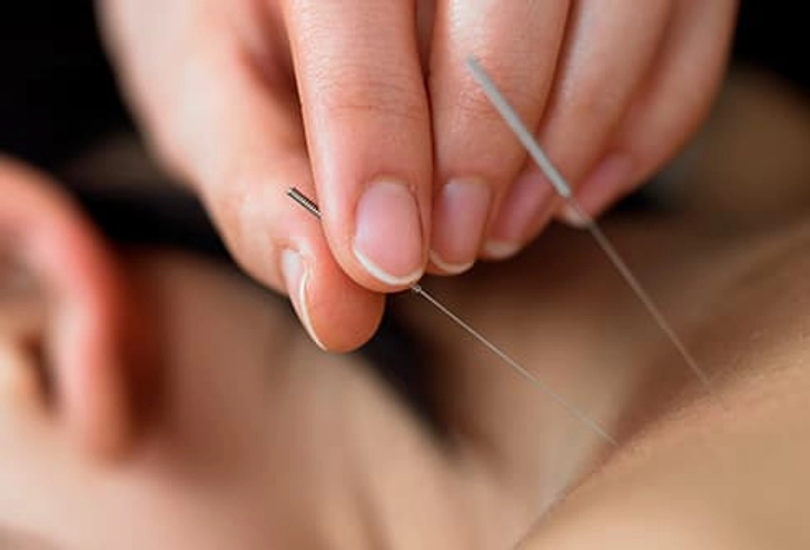 Acupuncture