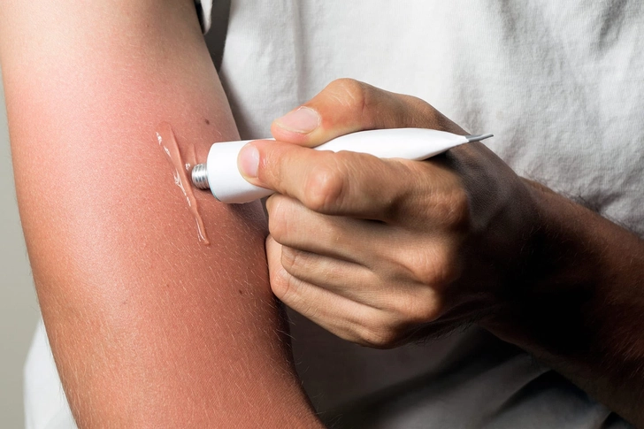 Sunburn First Aid