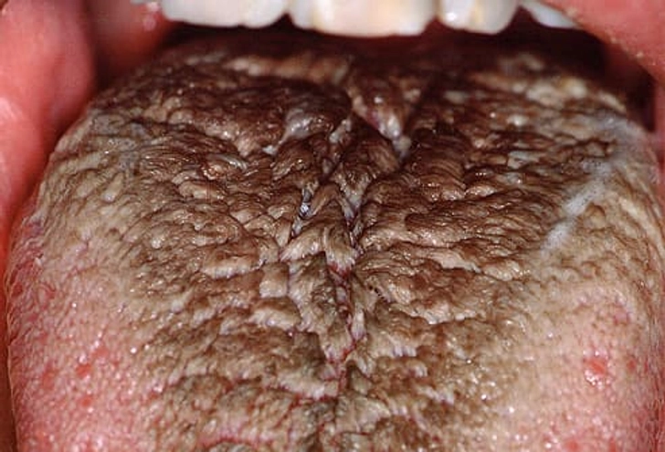 Black Hairy Tongue Black Hairy Tongue