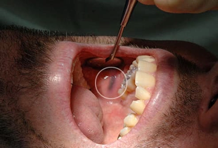 Amalgam Tattoo Amalgam Tattoo