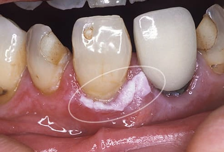 Leukoplakia Leukoplakia