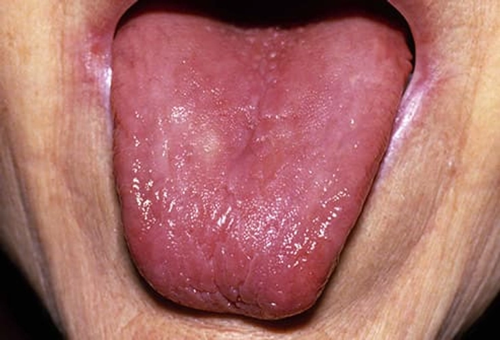 Bald Tongue Bald Tongue