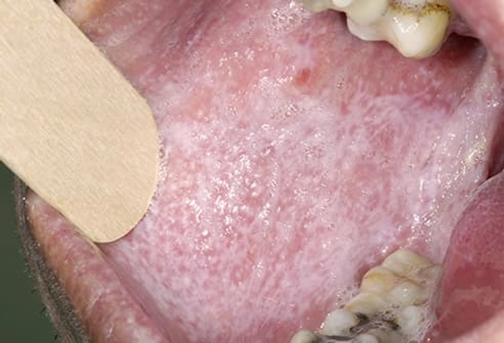 Reticular Lichen Planus