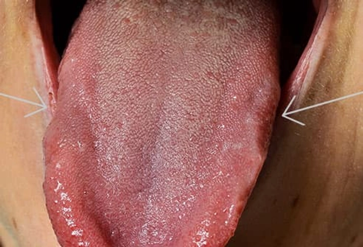 Scalloped Tongue