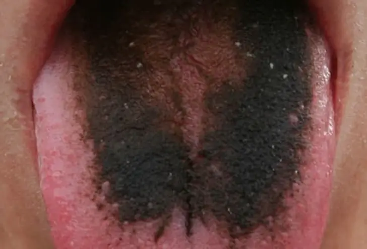 Black Hairy Tongue