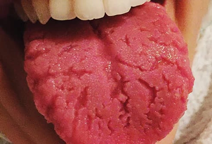 Fissured Tongue
