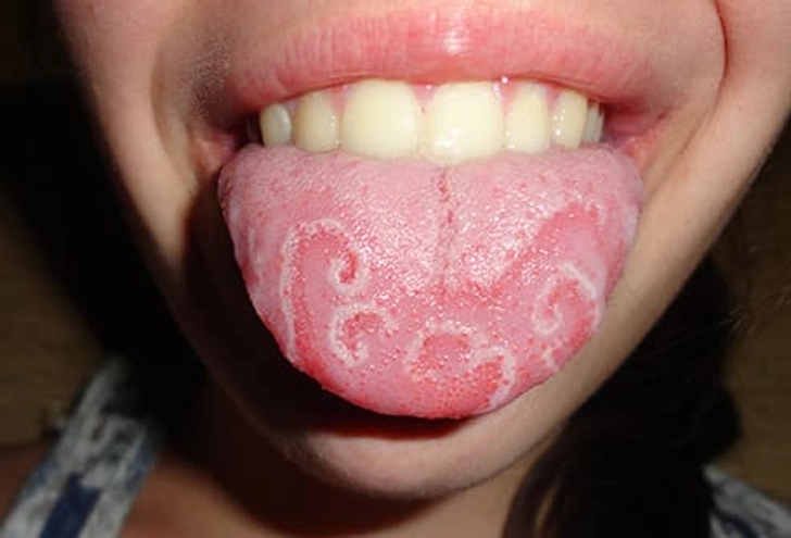 Geographic Tongue