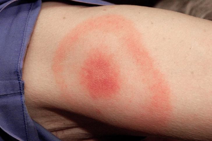 Lyme Disease Rash Lyme Disease Rash
