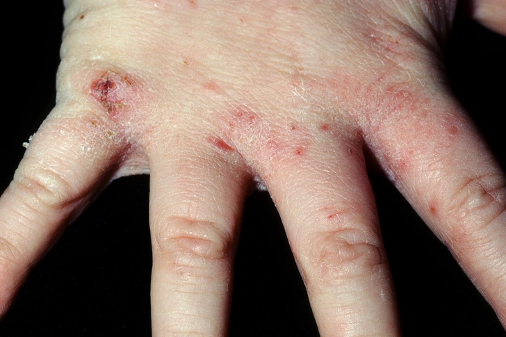Scabies