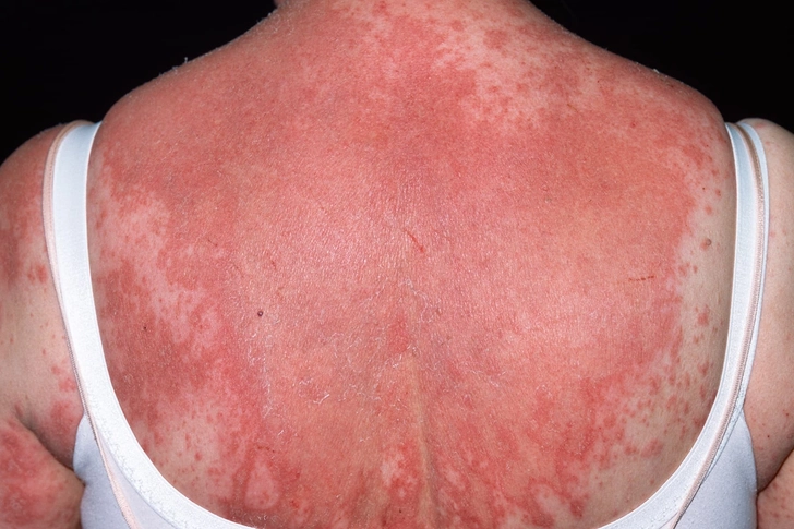 Drug Rash Drug Rash