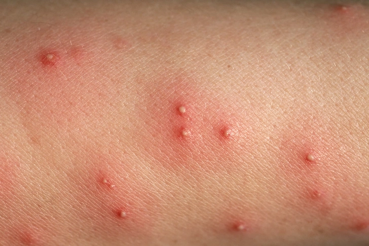 Fire Ant Bites