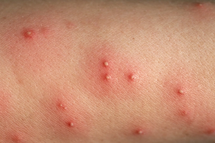 Fire Ant Bites Fire Ant Bites