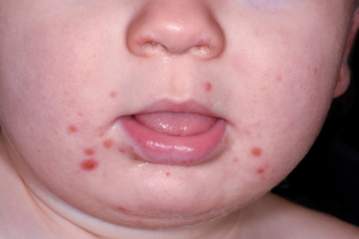 Hand-Foot-and-Mouth Disease
