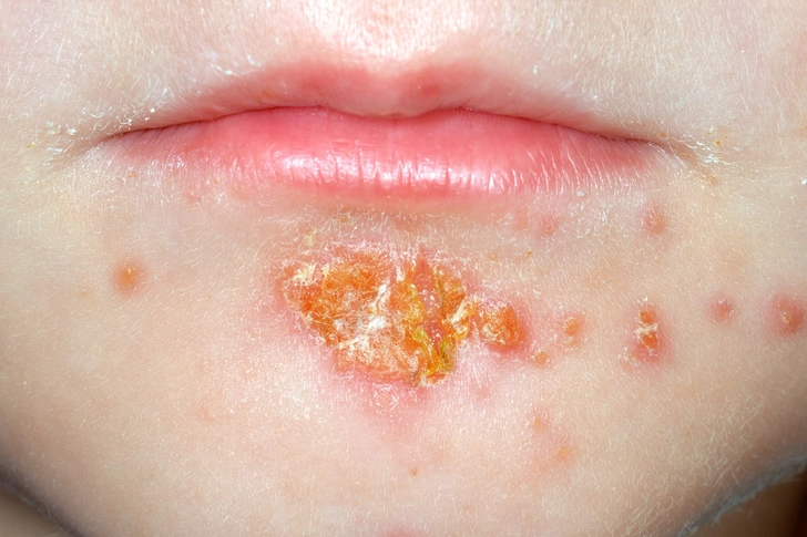 Impetigo