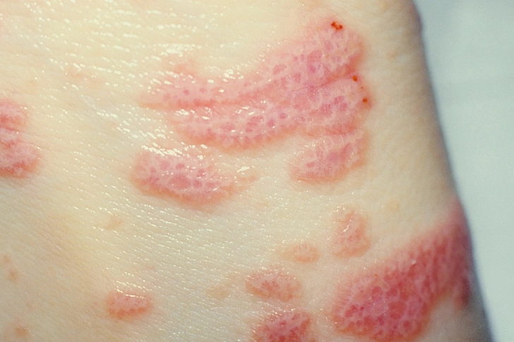 Lichen Planus Lichen Planus