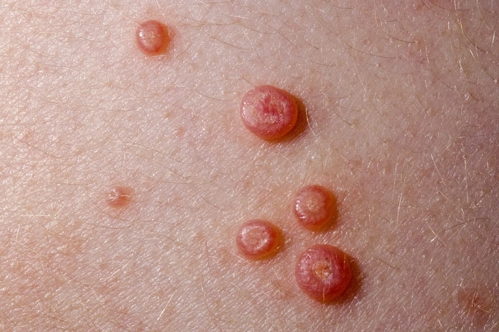 Molluscum Contagiosum Molluscum Contagiosum