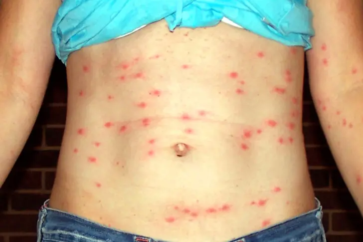 Chigger Bites
