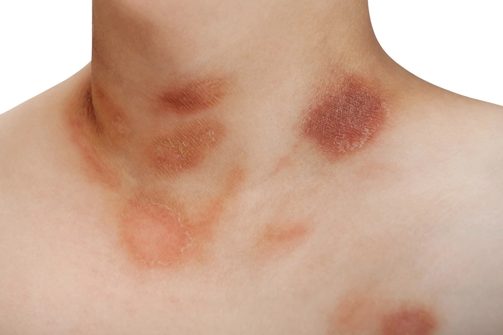 Christmas Tree Rash
