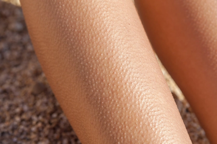Goosebumps