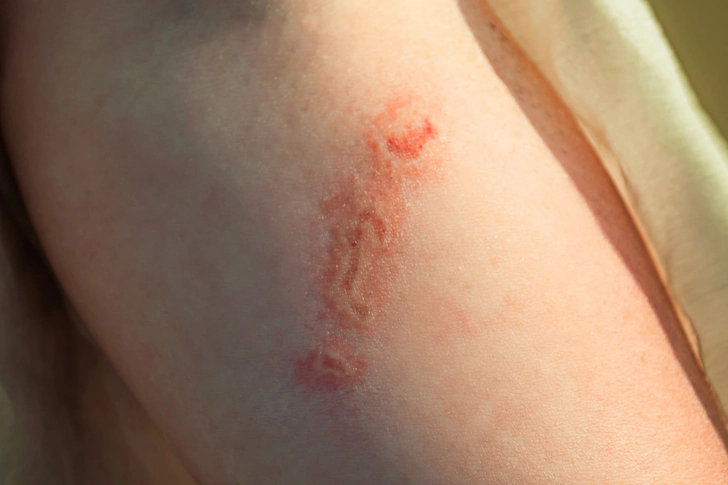 Jellyfish Sting