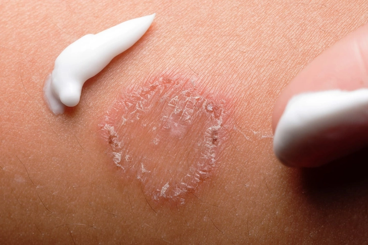 Ringworm Ringworm