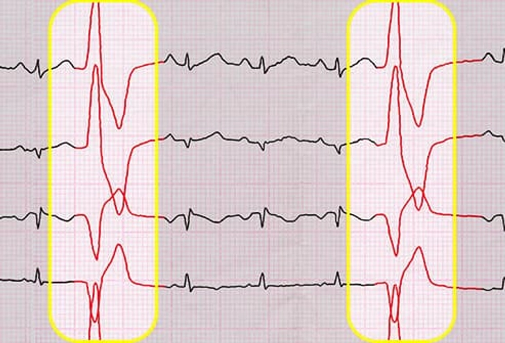 Premature Ventricular Contractions