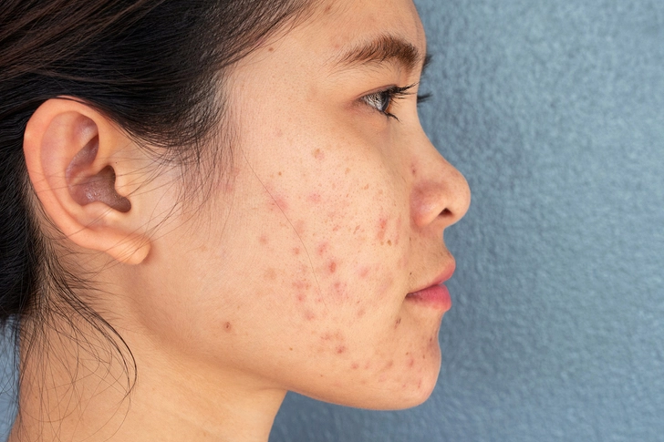 Acne