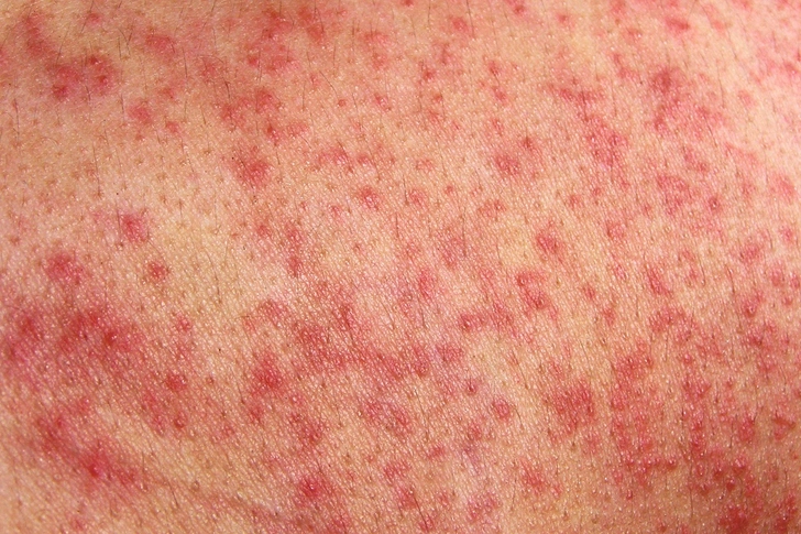 Skin Allergies