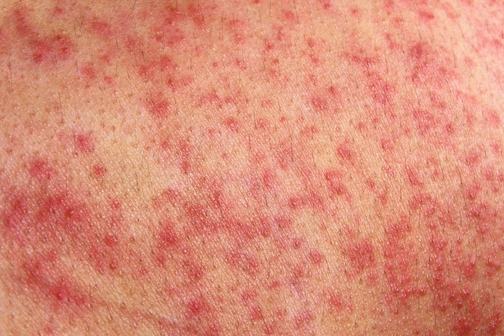 Skin Allergies Skin Allergies