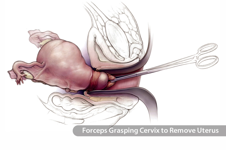 Hysterectomy