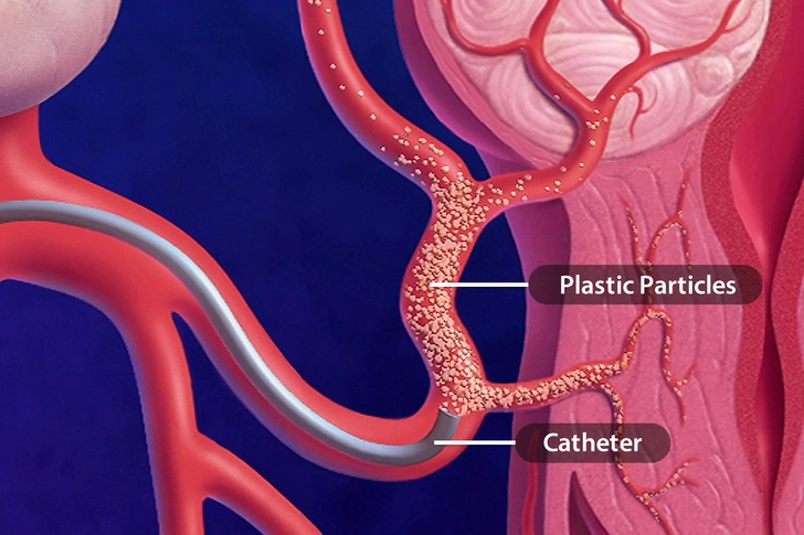 Uterine Artery Embolization