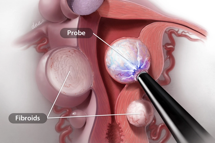 Radiofrequency Ablation