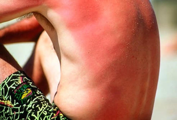 Sunburn
