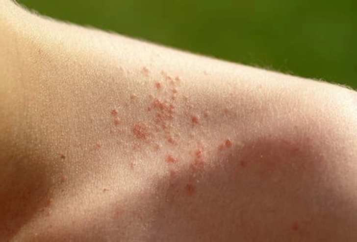 Heat Rash