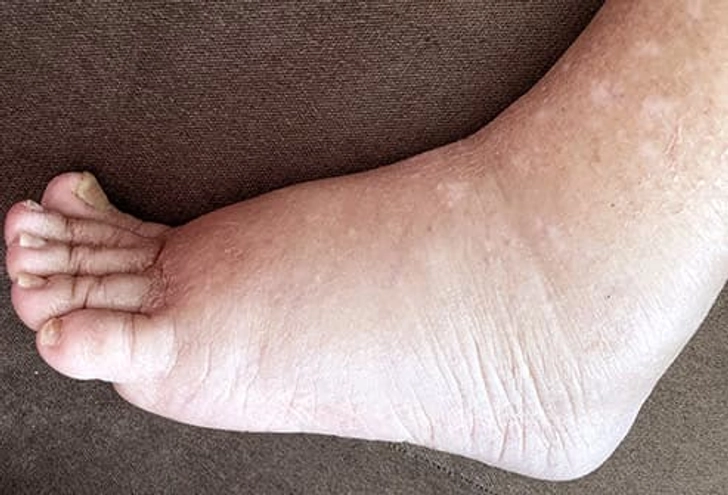 Heat Edema
