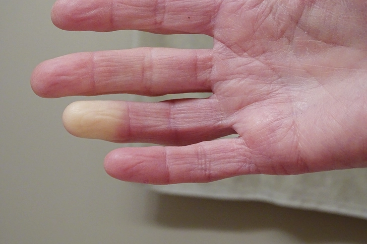 Cause: Raynaud's Syndrome